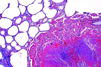 Mikropräparat - Miliartuberkulose der Lunge, Tuberculosis miliaris pulmonum