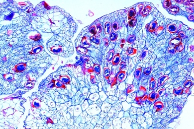 Mikropräparat - Synchytrium endobioticum, Kartoffelkrebs, infizierte Knolle, quer, Algenpilze (Phycomycetes)