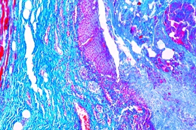 Mikropräparat - Nekrotisierende Oesophagitis, Krankhafte Veränderungen der Zellen und Gewebe