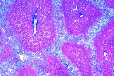 Mikropräparat - Leberzirrhose, Krankhafte Veränderungen der Zellen und Gewebe
