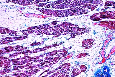 Mikropräparat - Fettherz, Adipositas cordis, Schädigungen der Kreislauforgane (Herz, Gefäße) und der blutbildenden Organe