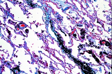 Mikropräparat - Kohlenstaublunge, Anthracosis pulmonum, Pathologische Veränderungen der Lunge und der Leber, Tuberkulose und Lungenentzündung