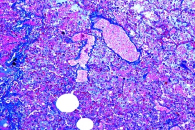 Mikropräparat - Grippepneumonie (Grippe-Lunge), Pathologische Veränderungen der Lunge und der Leber, Tuberkulose und Lungenentzündung