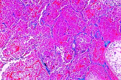 Mikropräparat - Nekrotische käsige Pneumonie, Pathologische Veränderungen der Lunge und der Leber, Tuberkulose und Lungenentzündung