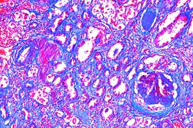 Mikropräparat - Schrumpfniere (Glomerularatrophie), Reaktionen der Nieren bei Arteriosklerose, Stoffwechselstörungen und Entzündungen, Dickdarmentzündung