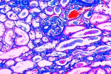 Mikropräparat - Amyloid-Degeneration der Niere (Amyloidose), Reaktionen der Nieren bei Arteriosklerose, Stoffwechselstörungen und Entzündungen, Dickdarmentzündung