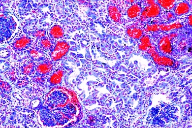 Mikropräparat-Akute hämorrhagische Nierenentzündung (Nephritis), Reaktionen der Nieren bei Arteriosklerose, Stoffwechselstörungen, Dickdarmentzündung