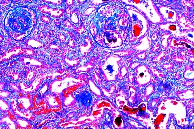 Mikropräparat - Chronische Glomerulonephritis, Reaktionen der Nieren bei Arteriosklerose, Stoffwechselstörungen und Entzündungen, Dickdarmentzündung