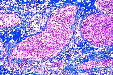 Mikropräparat - Gumma testis, im Tertiärstadium der Syphilis