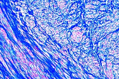 Mikropräparat - Gebärmuttermyom (Myoma uteri), Histologie der gut- und bösartigen Geschwülste