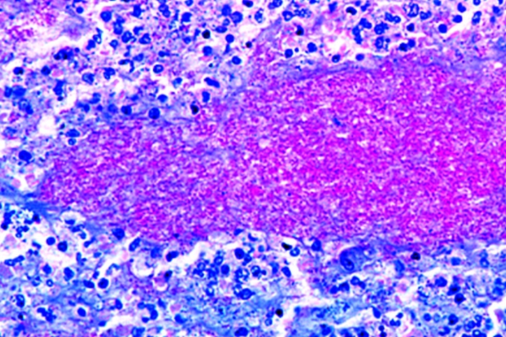 Mikropräparat - Mycobacterium tuberculosis. Gewebeschnitt mit Bakterien *