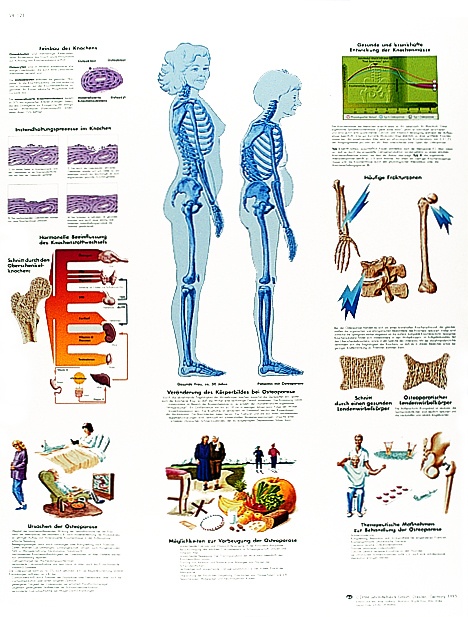 Anatomische Lehrtafel, Osteoporose