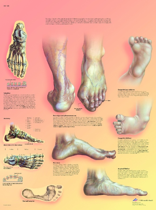 Anatomische Lehrtafel, Fehlstellungen der Füße