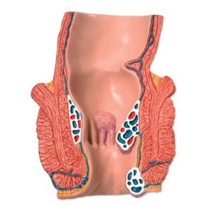 Hämorrhoidenmodell